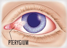 Pterygium